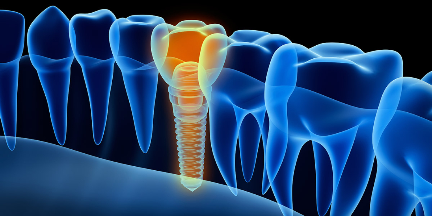 ¿Cómo funcionan los implantes dentales?